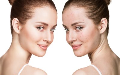 How to Minimize Post-Acne Marks (Scars)