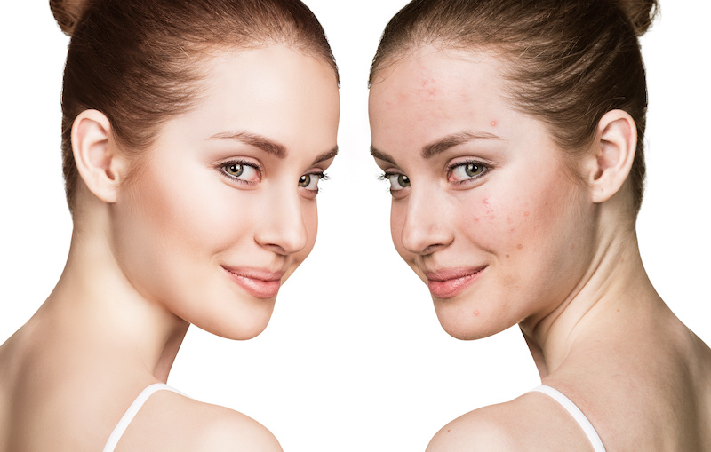 How to Minimize Post-Acne Marks (Scars)