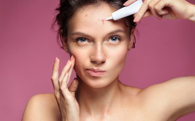 Guide to Popping Pimples the Right Way