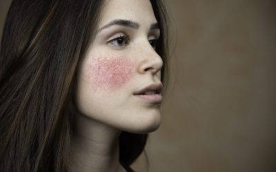 9 Signs of Sensitive Skin